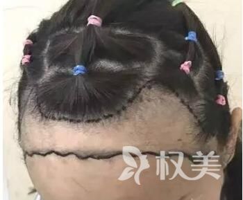 重庆植发有什么优点_重庆真伊发际线种植有啥注意事项