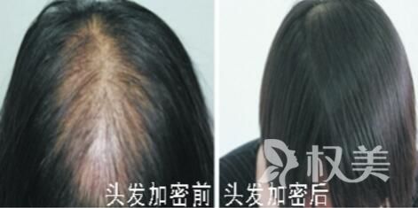 广州新发现植发整形医院植发怎么样_和戴假发有什么区别