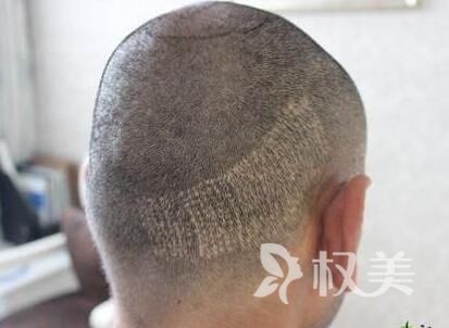 西京医院植发科怎么样 疤痕植发效果理想吗