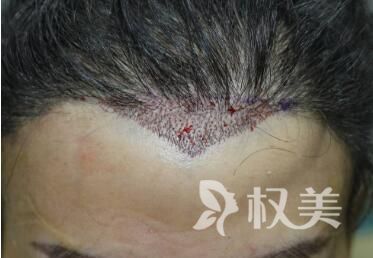 女性植发需要剃光头吗_武汉新生整形医院美人尖种植价格