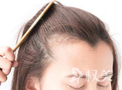 河南省植发研究院发际线种植 改善你的发际线过高问题