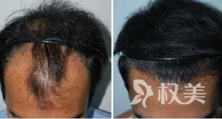哪些人可以做植发加密_贵阳美贝尔头发加密种植效果好吗