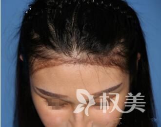 植发前需要考虑什么_南昌瑞丽诗植发需要注意些什么