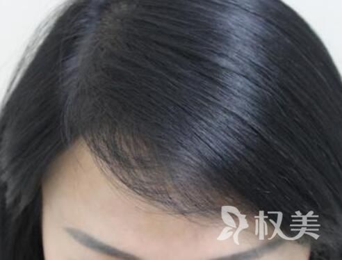 脑门大可以植发吗 贵阳美贝尔做发际线种植怎么样