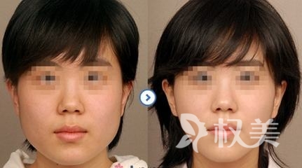 注射肉毒素sl 10-12周瘦脸效果最为明显