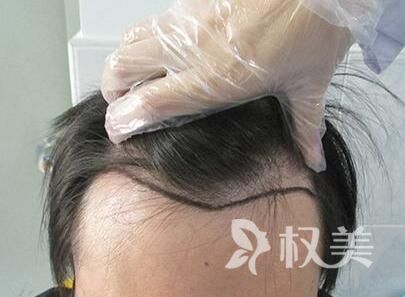 植发6个月效果图 发际线种植效果怎么样