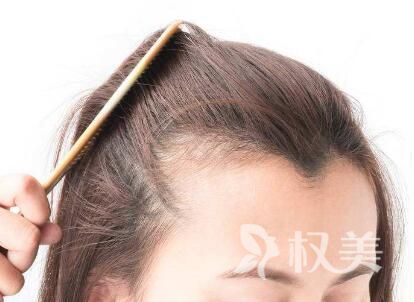 女性植发真实案例 济南瑞丽诗发际线种植有效果吗