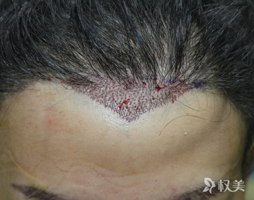 美人尖是什么 美人尖种植让你具有古典美