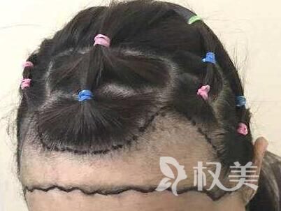 掉发怎么办 东莞雍禾发际线种植能改善吗