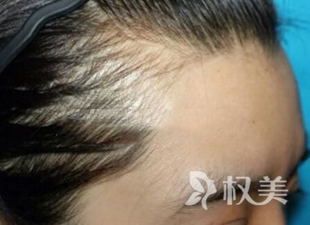 桑叶洗头能治脱发吗 成都瑞丽诗发际线种植