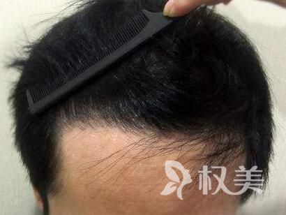 发际线后移擦生姜行吗 济南海峡发际线种植更靠谱