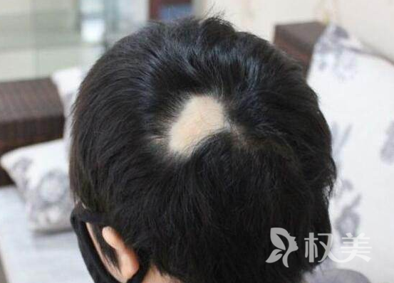 斑秃挂什么科 疤痕植发有没有后遗症