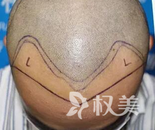 什么是侧柏叶 头发种植的效果如何