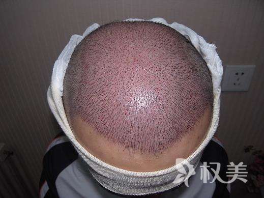 脱发对比图 头发种植能治好脱发吗
