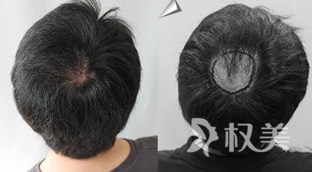 头发稀少怎么办  加密种植头发需要多少钱