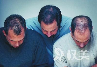 头顶脱发怎么办 头发加密种植前有哪些准备