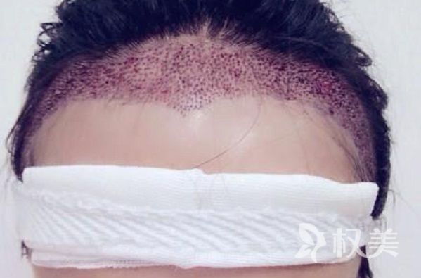 美人尖适合什么发型 种植美人尖效果好不好