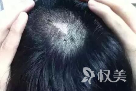 女生秃头怎么办 上海九院疤痕植发摆脱疤痕尴尬