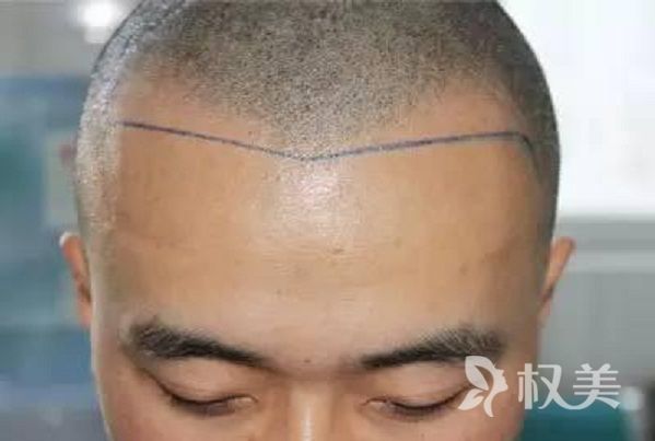先天发际线就很高怎么办 发际线种植后为什么会脱落