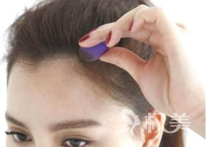 发际线过高怎么办 江苏人民医院发际线种植有效果吗