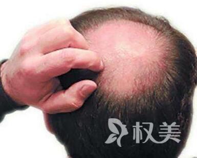 谢顶怎么办 贵阳雍禾头发种植摆脱地中海