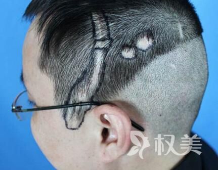 防脱发小妙招有哪些 北京丽都疤痕植发有效果吗