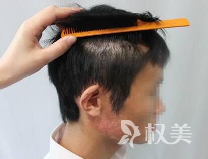 北京武警总队第三医院疤痕植发 解决疤痕烦恼