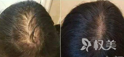 头发稀疏加密种植后头要疼痛多久 头发种植后为什么会痒呢