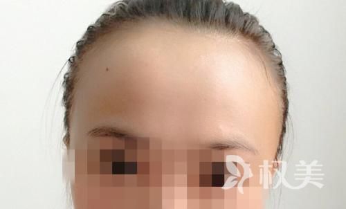 发际线为什么会后移呢 头发种植的效果如何