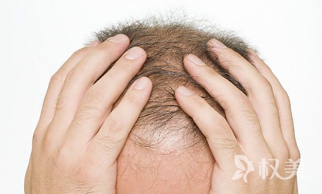 什么是头发种植 植发术后护理要收费吗
