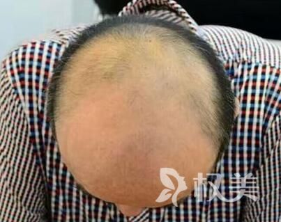 宁波美莱植发价格表 秃顶头发种植多少钱