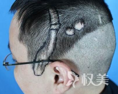 斑秃挂什么科 北京南加美学疤痕植发优势