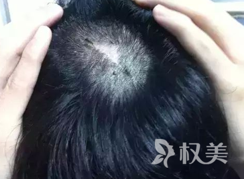 头上的疤痕怎么才能长出头发 疤痕植发多久可以看到效果