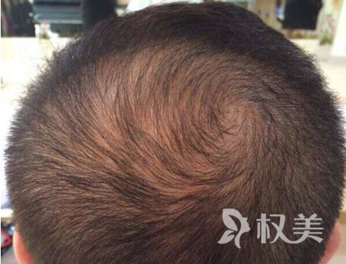 为什么最近老是掉头发 苏州头发加密种植哪家医院好