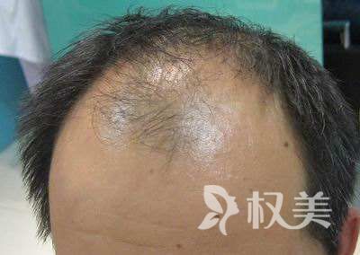 男性为什么秃顶呢 头发加密种植多少钱