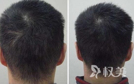 济南植发哪家好 济南科发源头发加密多久见效