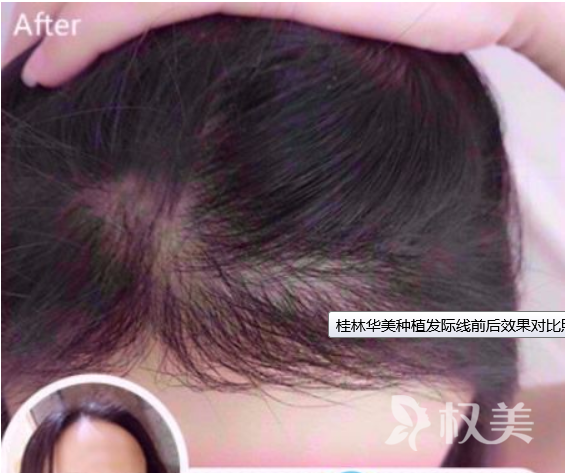 头发加密种植需要多少钱  温州头发加密移植哪家好
