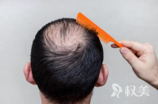 头顶头发掉落严重怎么办 头发加密手术的效果如何