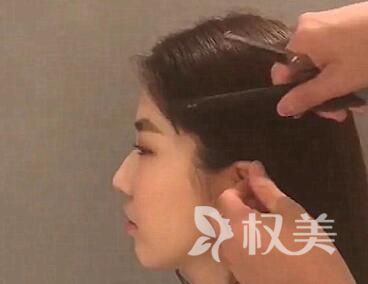 女生鬓角头发稀少怎么办 石家庄科发源鬓角种植效果