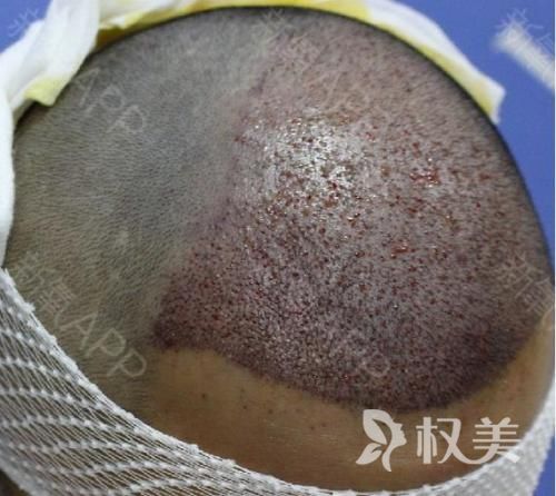 头发种植时可以不打麻药吗  成都碧莲盛头发种植价格
