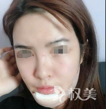 萍乡人民医院整形科 隆下巴整形 助我蜕变完全女人