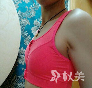广州医科大学附属医院整形科假体隆胸 轻松拥有蜜桃胸
