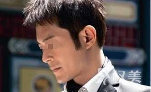 鬓角为什么会脱落呢 无锡坤如玛丽鬓角种植技术有哪些