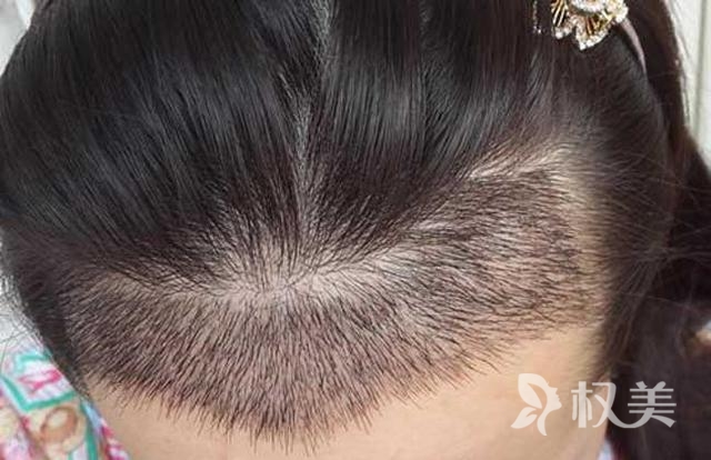 发际线后移是什么原因 头发种植术分为哪几个步骤
