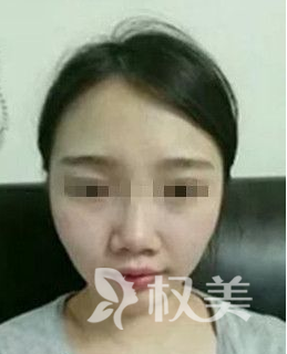 为了美我行动起来了 高颧骨缩小手术让我面部轮廓变清晰 