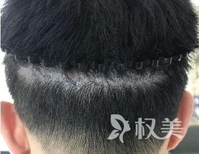 什么是头发种植 北京疤痕植发医院哪家好
