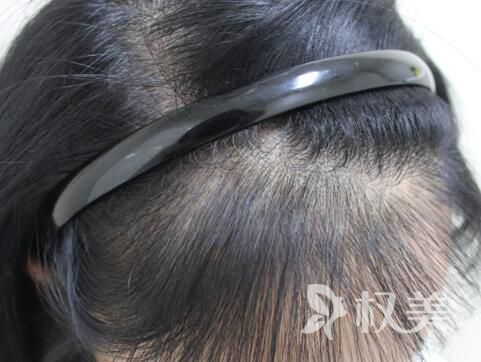 洗头掉多少头发算正常 发际线种植注意事项有哪些