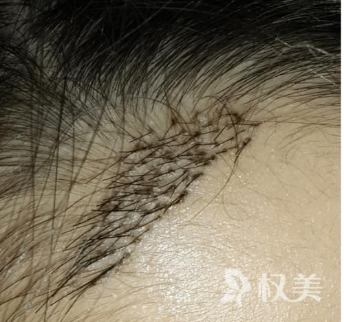 深圳哪里植发好 种植头发的原理是什么