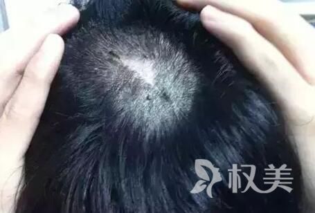 植发后恢复过程是怎样的 疤痕植发多久能恢复