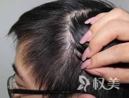 掉头发是什么原因引起的 疤痕植发需要注意些什么